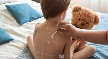 Das Bild zeigt, wie ein Junge, der an Windpocken erkrankt ist, mit einer juckreizstillenden Lotion behandelt wird